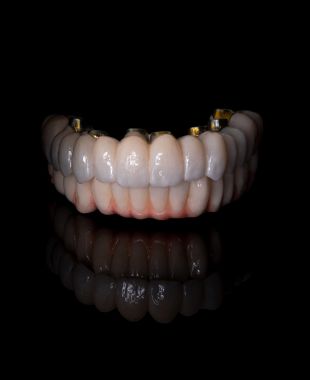 Prótesis híbrida sobre implantes con encía caracterizada – Juiz Dental