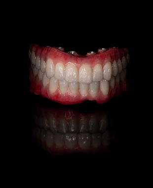 Sobredentadura completa sobre barras implantosoportadas – Juiz Dental
