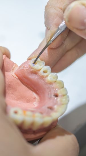 Detalles de la caracterización estética de una prótesis dental realizada en Juiz Dental