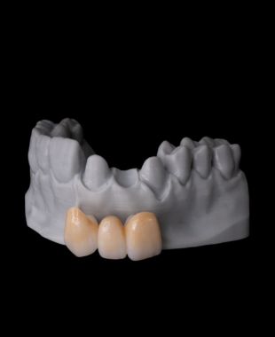 Estructura dental en zirconio con coronas cerámicas – Juiz Dental